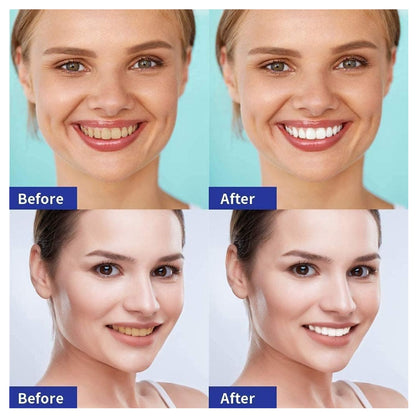 5D White® Tiras de Blanqueamiento Dental X14