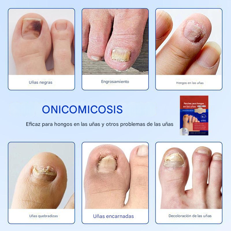 ClearNail® | PARCHES PARA UÑAS CON HONGOS ★ Tratamiento para uñas sanas