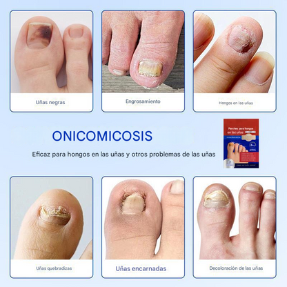 ClearNail® | PARCHES PARA UÑAS CON HONGOS ★ Tratamiento para uñas sanas