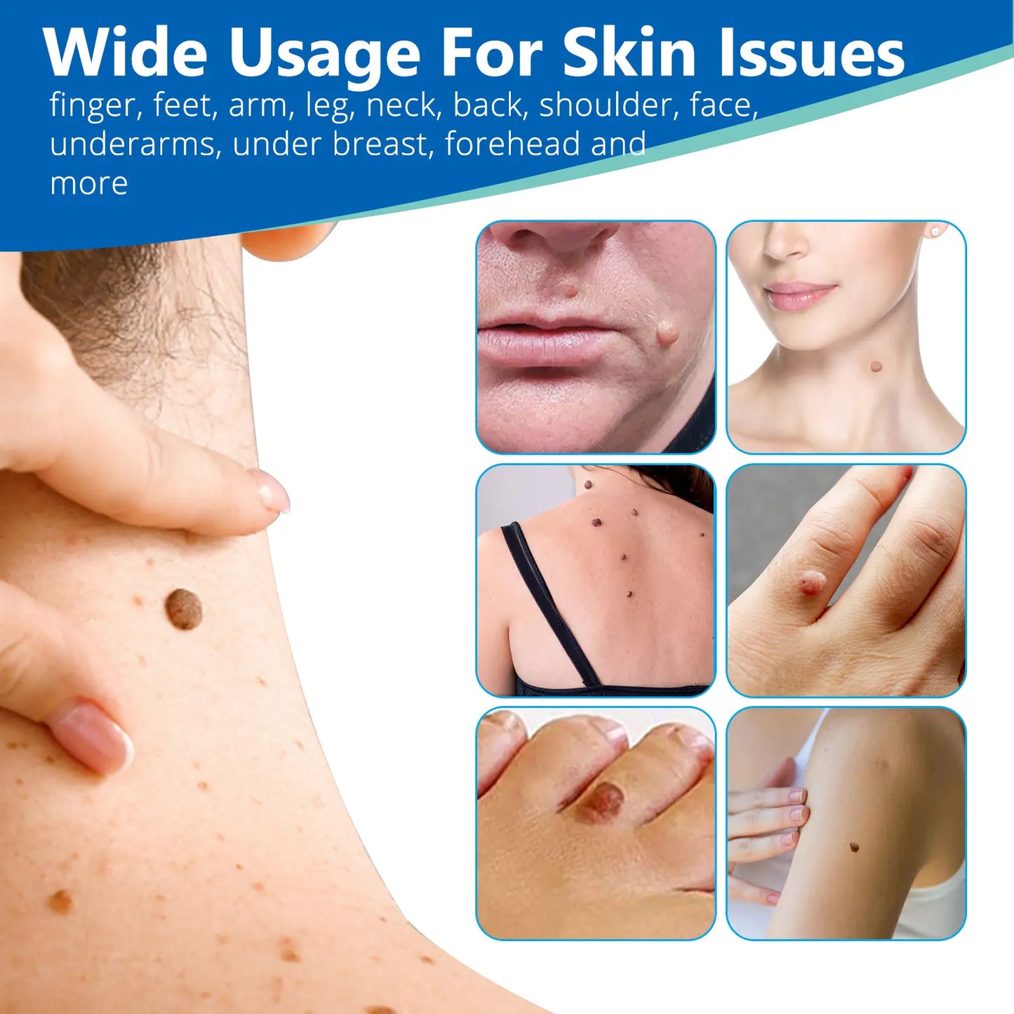 KIT PROFESIONAL DE ELIMINACIÓN DE VERRUGAS 2 EN 1® Sin químicos ni procesos dolorosos