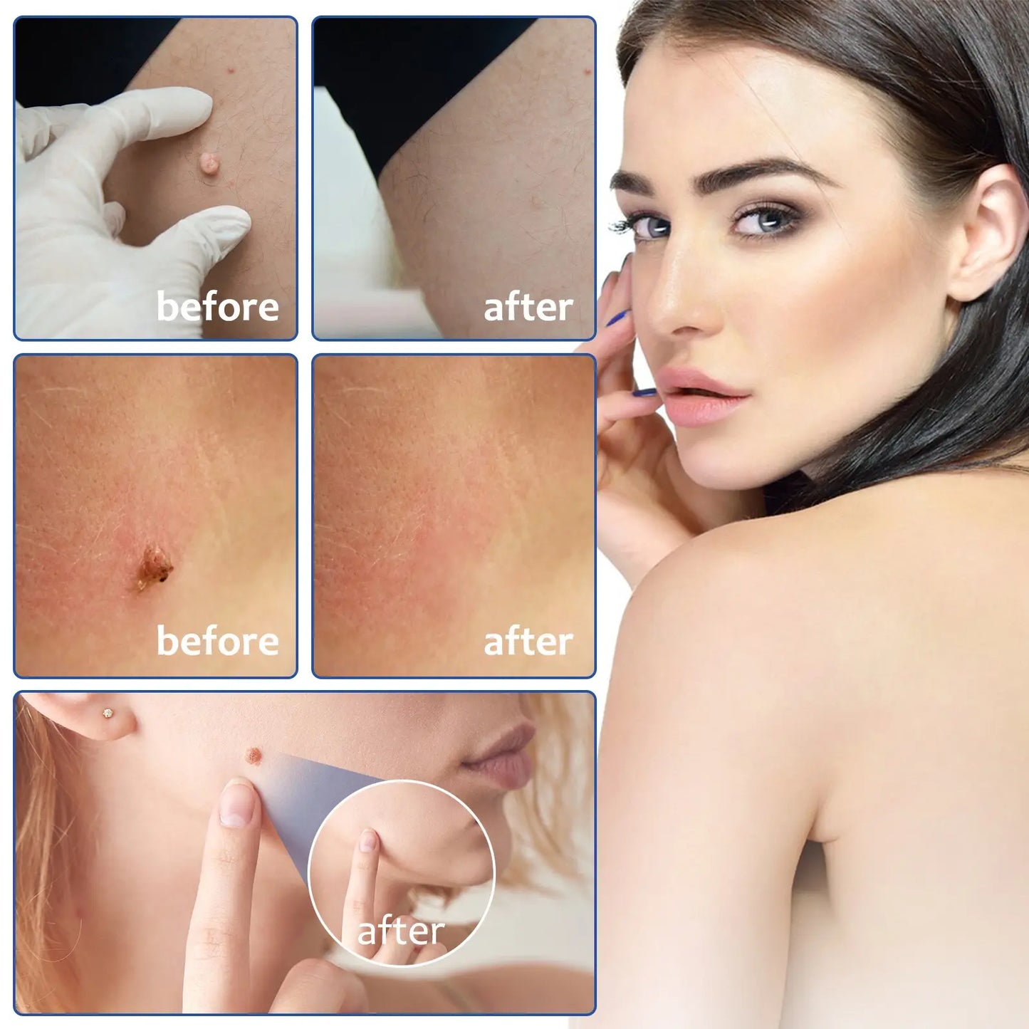 KIT PROFESIONAL DE ELIMINACIÓN DE VERRUGAS 2 EN 1® Sin químicos ni procesos dolorosos