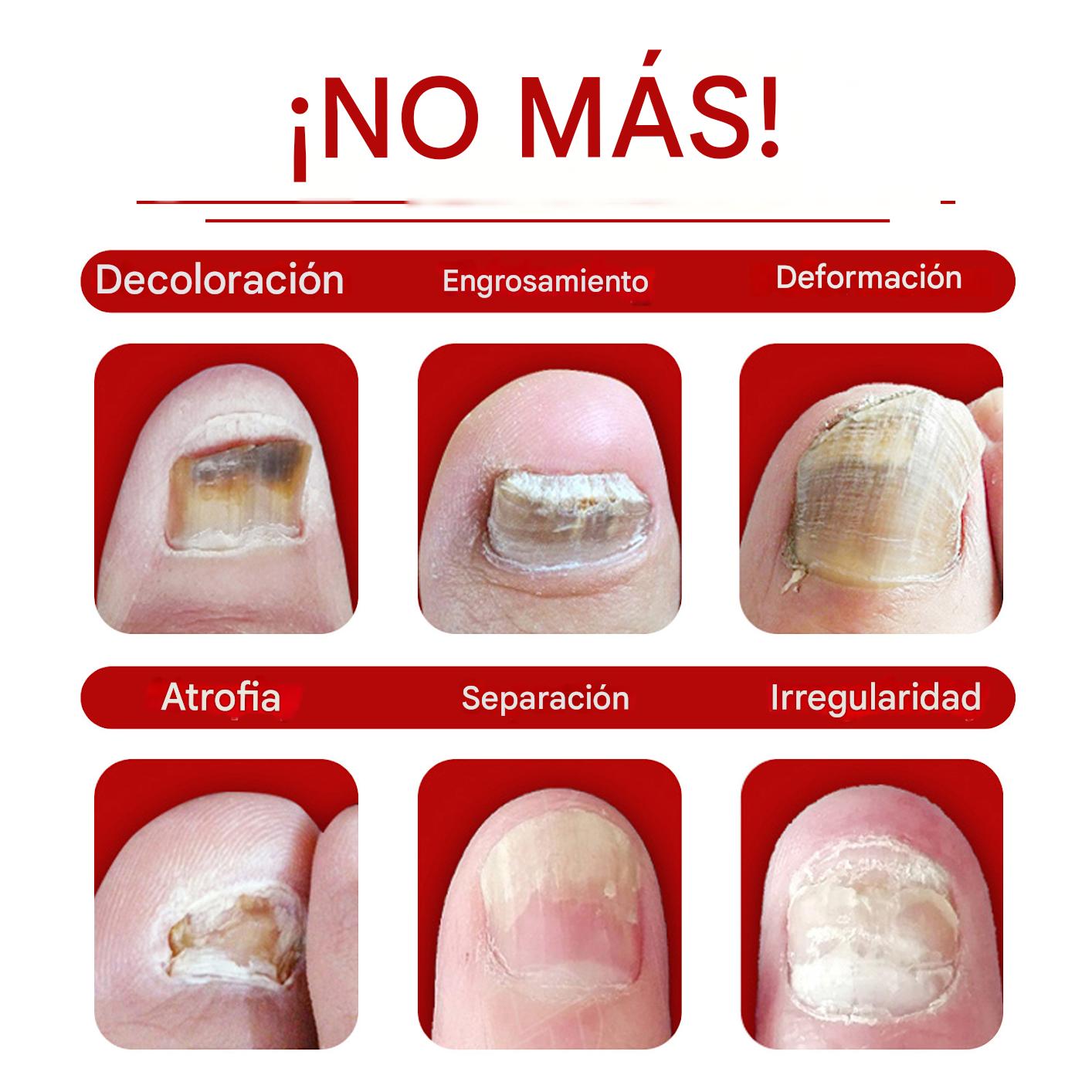 Fungi-Fix™ | TRATAMIENTO ANTIHONGOS PARA LAS UÑAS X2 PCS ★ Resultados garantizados en 7 días