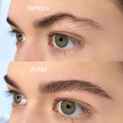 DermaRoller® Rodillo Con Micro-Agujas Para el Crecimiento de Vello