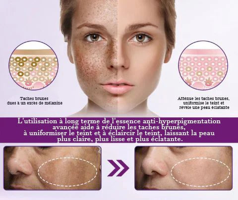 Radiant Skin PRO® | SÉRUM DESPIGMENTADOR ANTIMANCHAS ★ Corrector de Manchas Oscuras