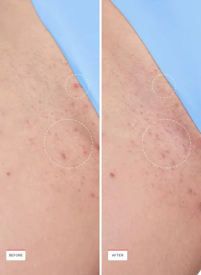 DermaClear® Tratamiento en Roll-ON para Cabello Encarnado